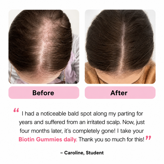 Biotin Gummies for Hair, Skin & Nails | 5000 mcg Biotin + Vitamins C & E + Zinc