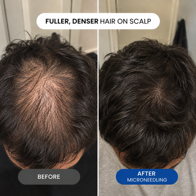 The Follicle-Targeted Peptide Infusion Hair Regrowth System